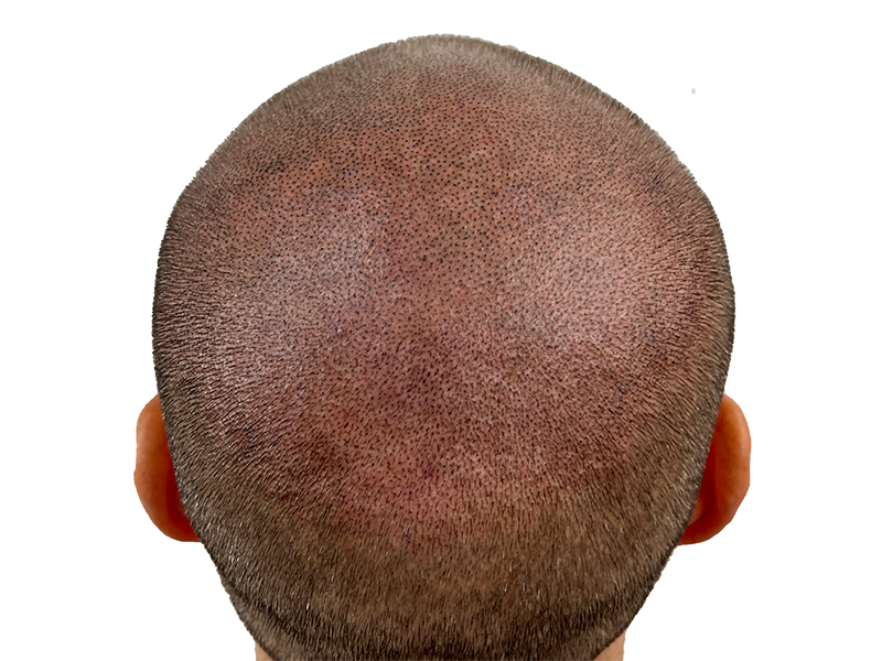 Hair transplant before & after: Caucasian male with restored hairline. Noticeable hair restoration results.