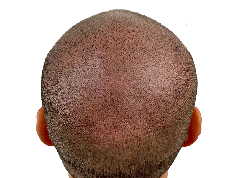 Hair transplant before & after: Caucasian male with restored hairline. Noticeable hair restoration results.