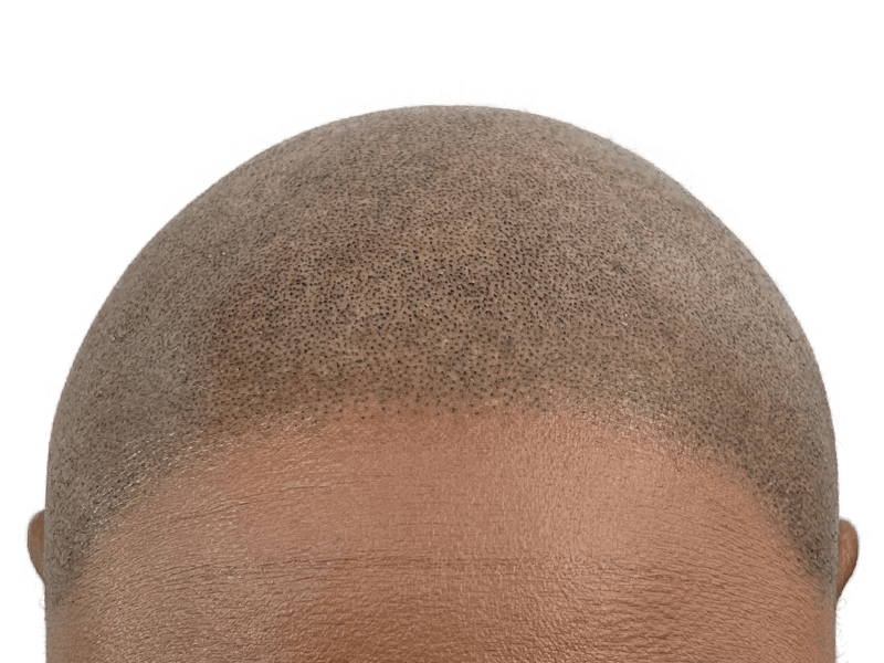 Hair transplant close-up: Scalp showing even follicle distribution, possibly post-procedure. Hair restoration result.