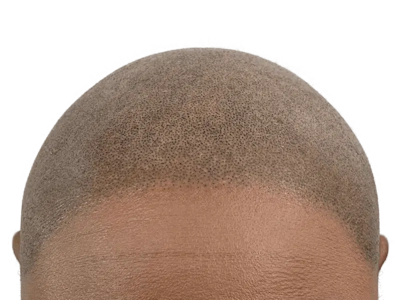 Hair transplant close-up: Scalp showing even follicle distribution, possibly post-procedure. Hair restoration result.