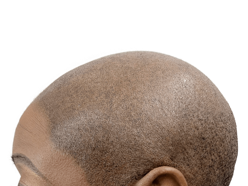 Hair transplant result: Natural hairline restoration on dark skin. Density & coverage visible. Before/after potential.