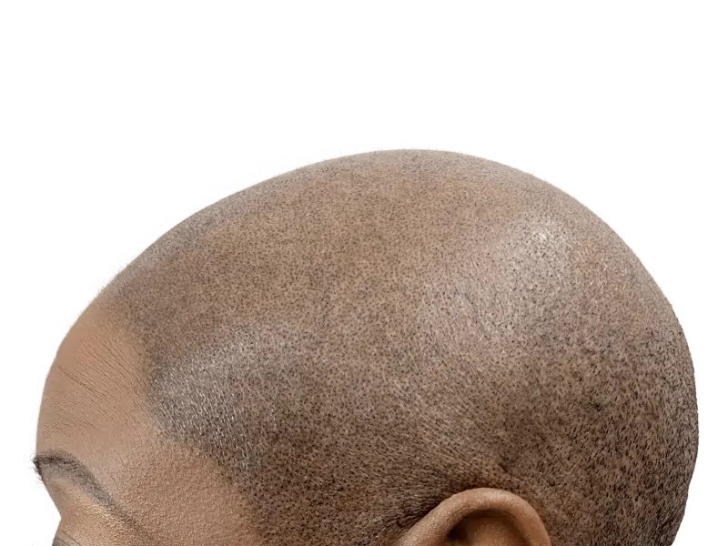 Hair transplant result: Natural hairline restoration on dark skin. Density & coverage visible. Before/after potential.