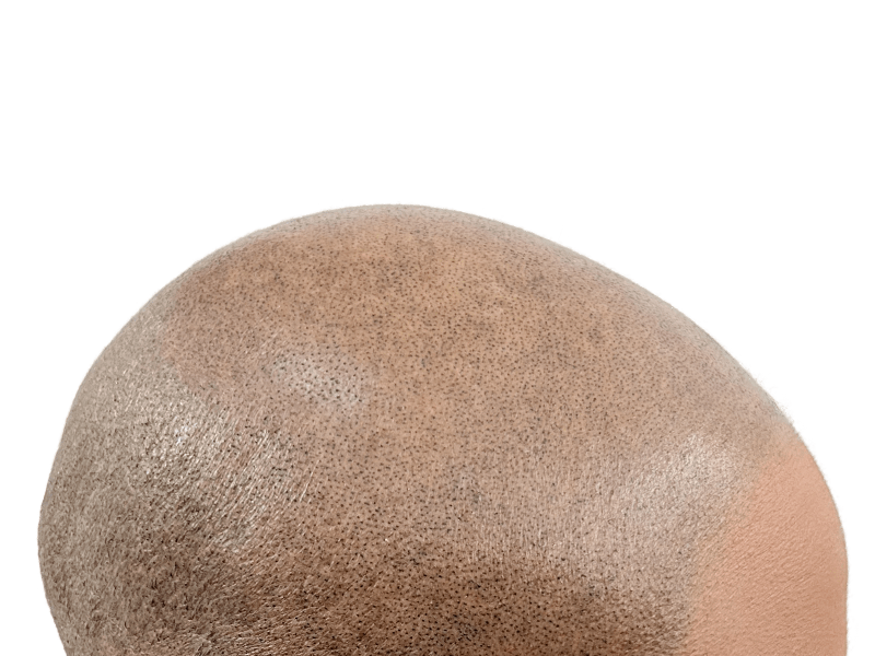 Hair transplant result: Dense follicle pattern on shaved scalp. Hair restoration success. Before/after available.