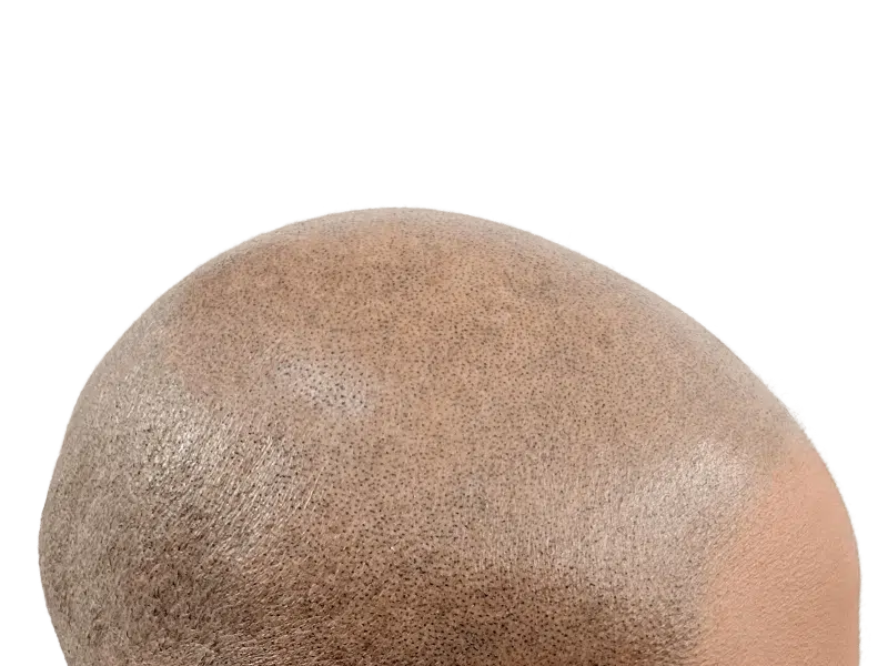 Hair transplant result: Dense follicle pattern on shaved scalp. Hair restoration success. Before/after available.