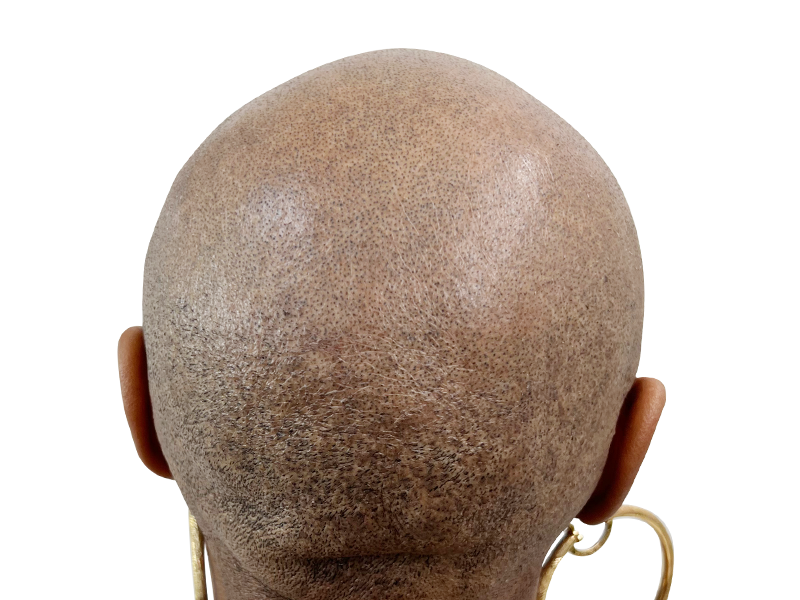 Bald head (back view). Hair restoration candidate? Potential hair transplant before photo. Shaved head reveals scalp.