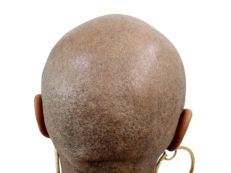 Bald head (back view). Hair restoration candidate? Potential hair transplant before photo. Shaved head reveals scalp.