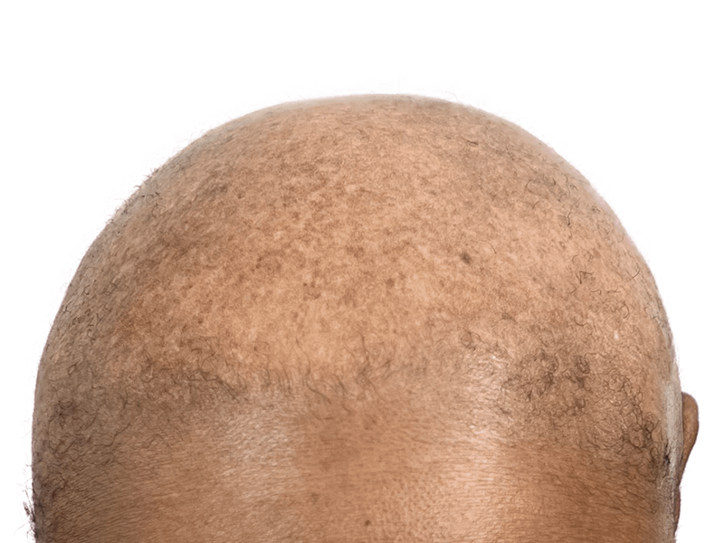 Sparse hair on dark skin. Potential hair transplant result. Before/after comparison needed for confirmation. Hair restoration.
