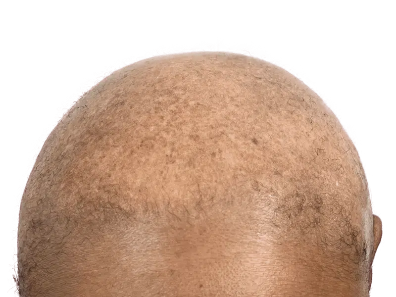 Sparse hair on dark skin. Potential hair transplant result. Before/after comparison needed for confirmation. Hair restoration.