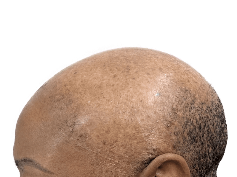 Hair transplant close-up: African American/Hispanic man's scalp showing follicle implants. Hair restoration results visible.
