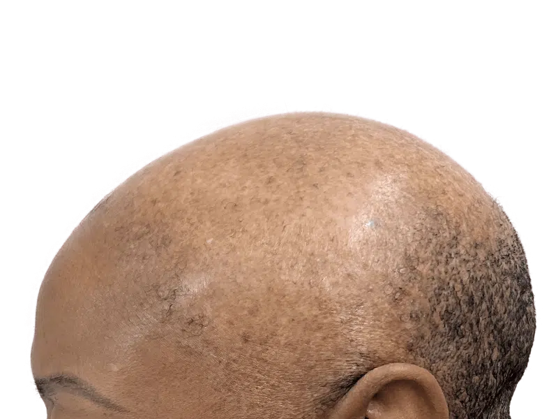 Hair transplant close-up: African American/Hispanic man's scalp showing follicle implants. Hair restoration results visible.