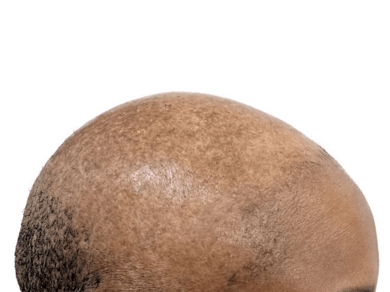 Hair transplant result: Bald African American man's head showing hair restoration progress. Before/after comparison.