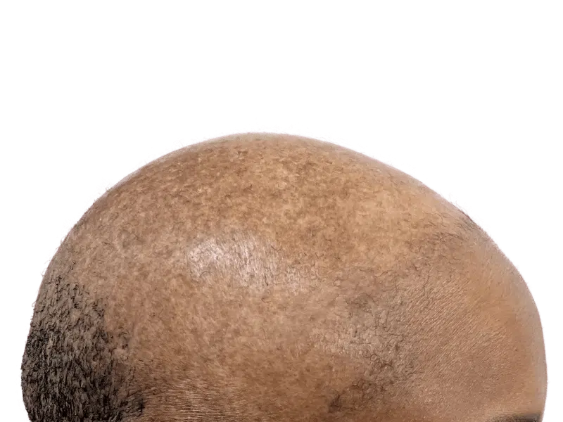 Hair transplant result: Bald African American man's head showing hair restoration progress. Before/after comparison.