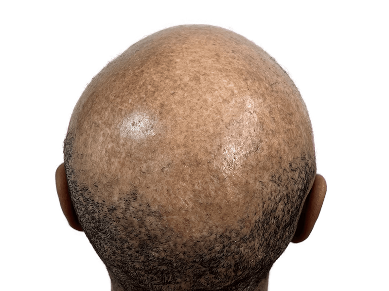 Hair restoration result: Bald scalp with new hair growth. Hair transplant success. Before & after example.