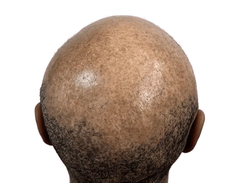 Hair restoration result: Bald scalp with new hair growth. Hair transplant success. Before & after example.