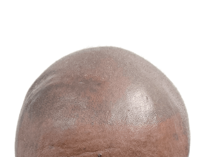 Hair transplant result: Bald African American man with new hairline. Hair restoration success.