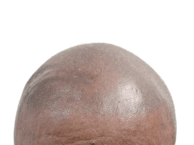 Hair transplant result: Bald African American man with new hairline. Hair restoration success.