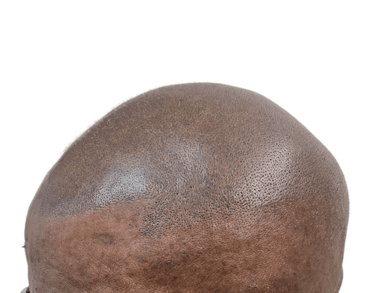 Hair restoration close-up: Dark skin, shaved head showing hair follicles. Potential hair transplant result, even density.