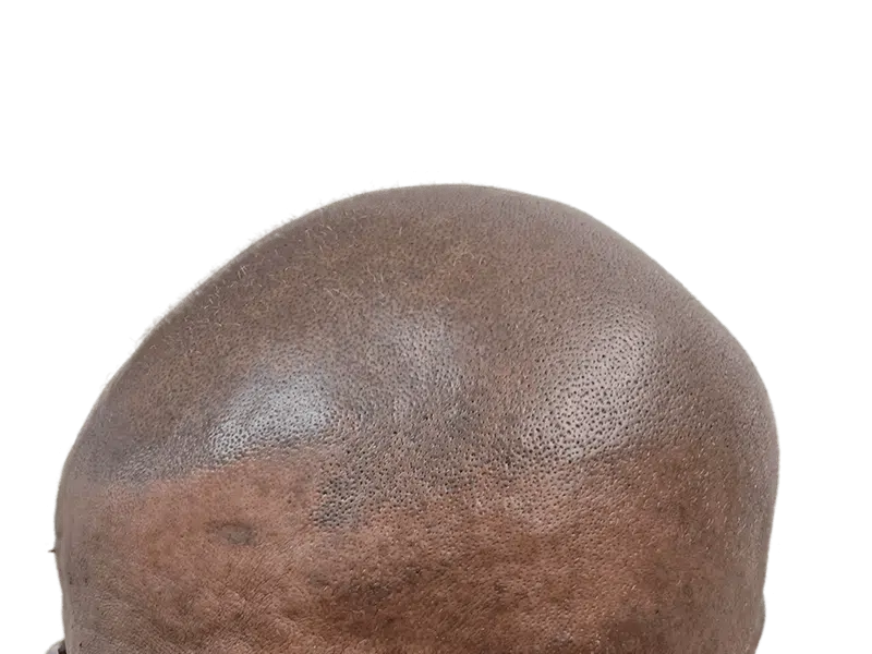 Hair restoration close-up: Dark skin, shaved head showing hair follicles. Potential hair transplant result, even density.