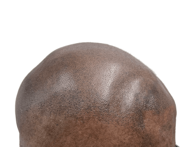 Before hair transplant: Bald African American man's head showing smooth skin and visible hair follicles. Hair restoration potential.