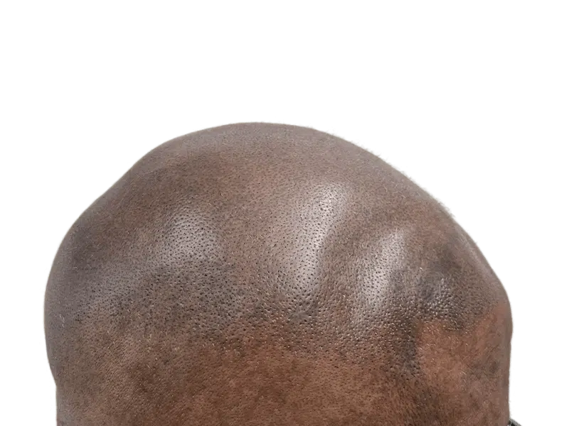 Before hair transplant: Bald African American man's head showing smooth skin and visible hair follicles. Hair restoration potential.