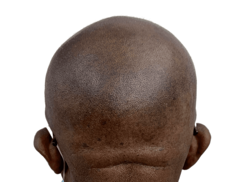 Shaved head, back view. Uniform skin tone. Potential hair transplant candidate. Before procedure assessment.