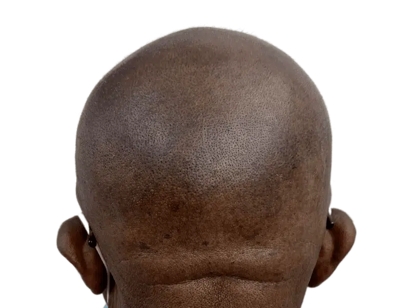 Shaved head, back view. Uniform skin tone. Potential hair transplant candidate. Before procedure assessment.