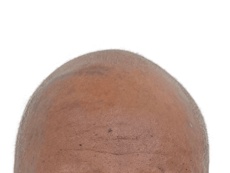 Balding scalp. Consider hair restoration options like hair transplants for fuller hair. Before treatment example.