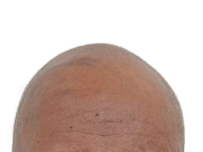 Balding scalp. Consider hair restoration options like hair transplants for fuller hair. Before treatment example.
