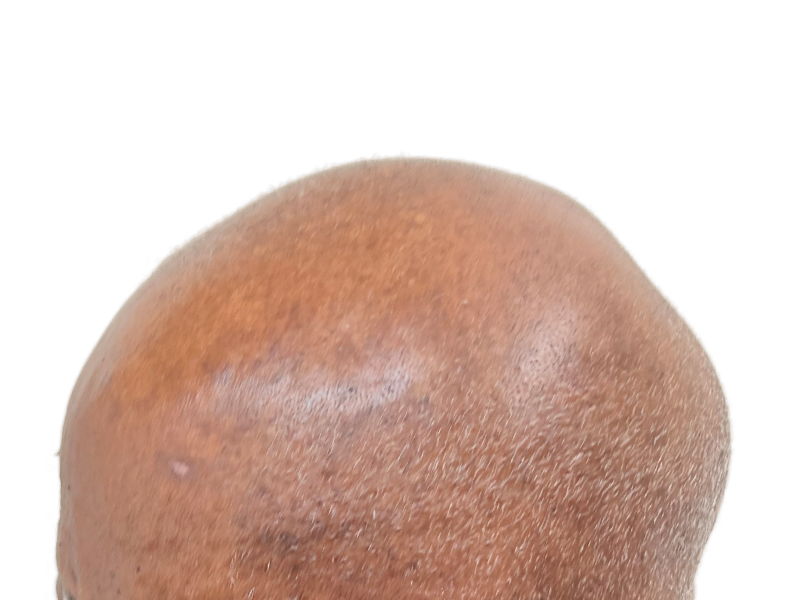 Hair transplant result: Close-up of restored hairline on dark skin. Noticeable density improvement. Hair restoration success.