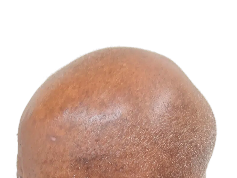 Hair transplant result: Close-up of restored hairline on dark skin. Noticeable density improvement. Hair restoration success.