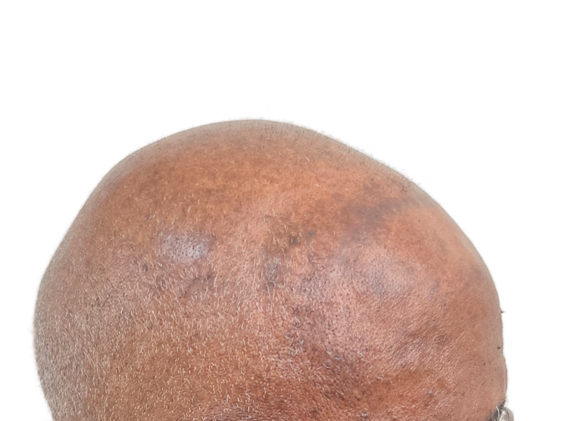 Bald African American/Hispanic male head. Potential hair transplant candidate. Before hair restoration treatment.