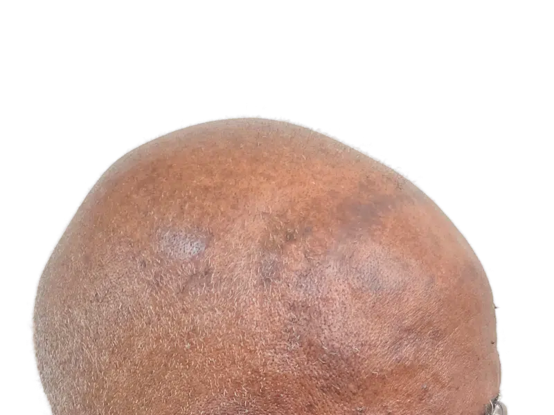 Bald African American/Hispanic male head. Potential hair transplant candidate. Before hair restoration treatment.