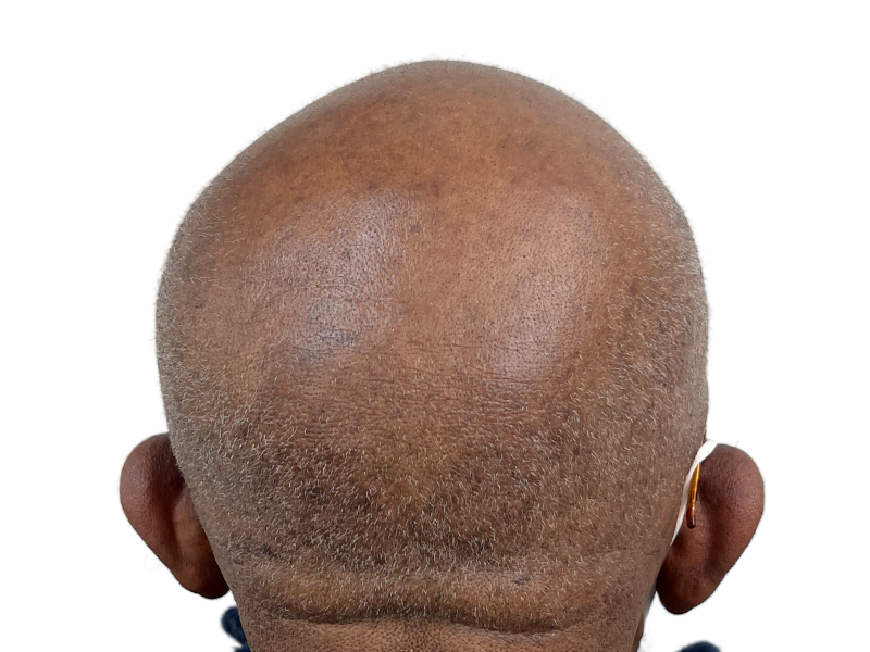 Hair transplant result: Back of head showing hair restoration progress. Baldness receding, new growth visible. Before/after potential.