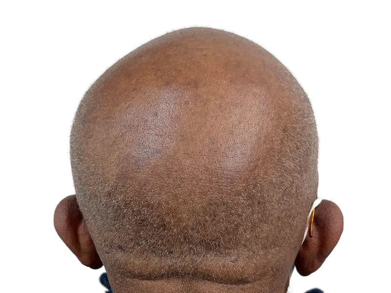 Hair transplant result: Back of head showing hair restoration progress. Baldness receding, new growth visible. Before/after potential.