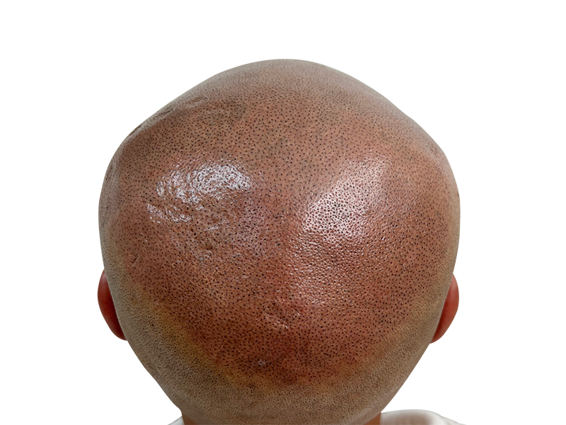 Hair transplant before & after: Caucasian male with restored hairline. Follicle placement visible. Hair restoration results.