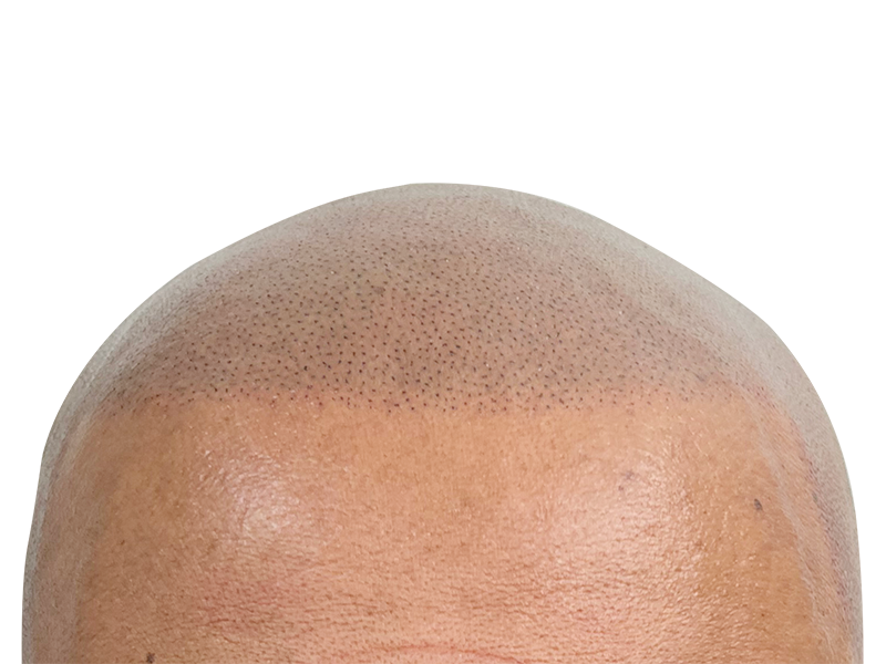 Hair transplant result: Close-up of restored hairline. Follicles visible, creating a closely cropped, fuller look. Hair restoration success.