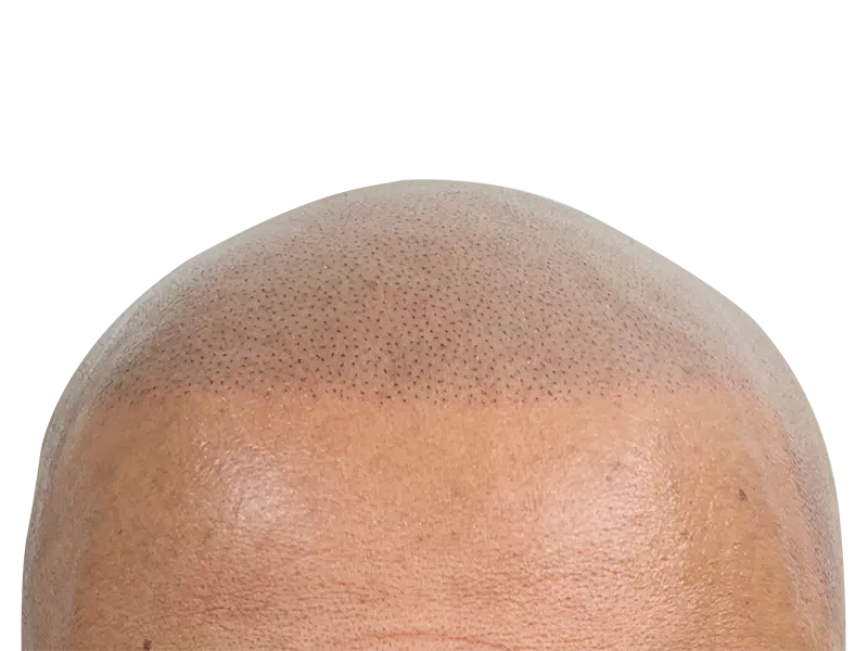 Hair transplant result: Close-up of restored hairline. Follicles visible, creating a closely cropped, fuller look. Hair restoration success.