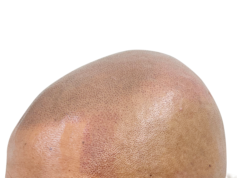Scalp Micropigmentation (SMP) close-up. Hair restoration treatment mimicking hair follicles. Before/after hair loss solution.