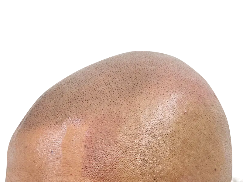 Scalp Micropigmentation (SMP) close-up. Hair restoration treatment mimicking hair follicles. Before/after hair loss solution.