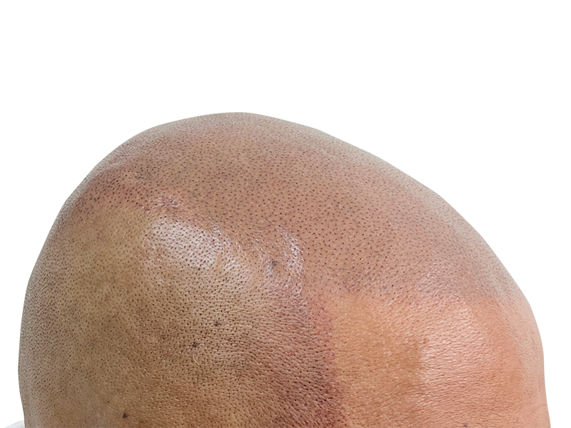 Hair transplant result: Close-up of scalp showing transplanted follicles. Hair restoration success. Before/after available.