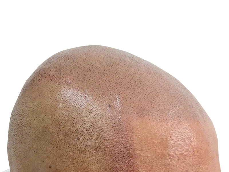 Hair transplant result: Close-up of scalp showing transplanted follicles. Hair restoration success. Before/after available.