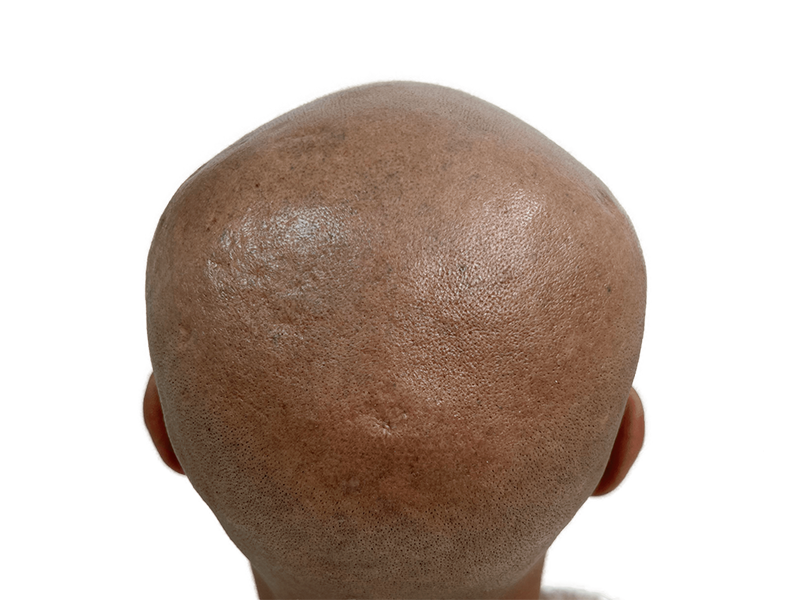 Hair transplant result: Close-up of restored hairline on dark skin. See density & even distribution after hair restoration.