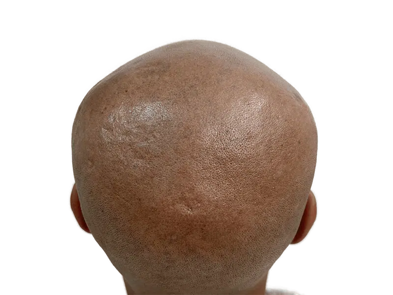 Hair transplant result: Close-up of restored hairline on dark skin. See density & even distribution after hair restoration.
