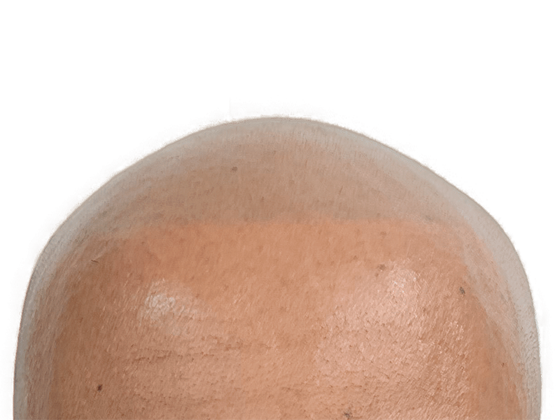 Balding scalp. Hair loss before hair restoration. Potential hair transplant candidate. Light to medium skin tone.