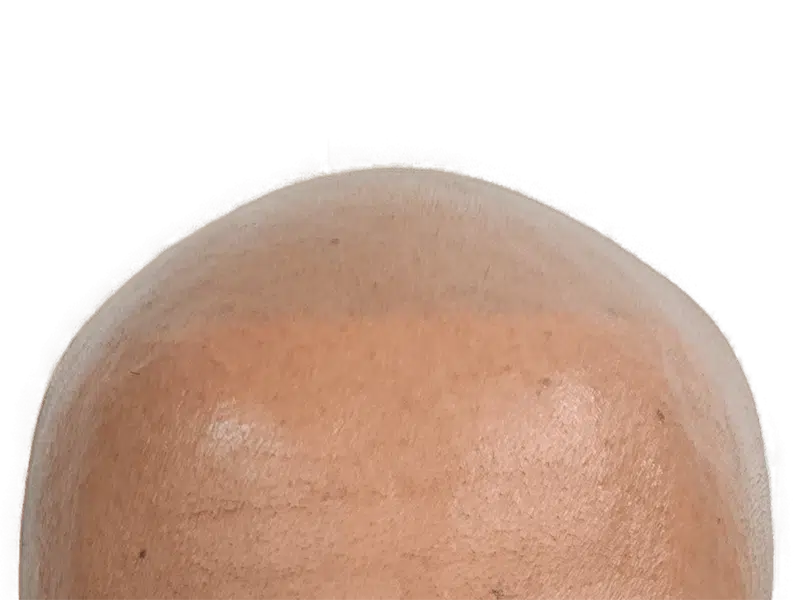 Balding scalp. Hair loss before hair restoration. Potential hair transplant candidate. Light to medium skin tone.
