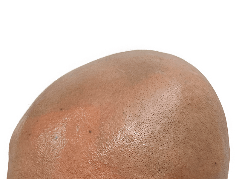 Hair transplant result: Fuller hair on dark skin. Before/after hair restoration showcasing density and even distribution.