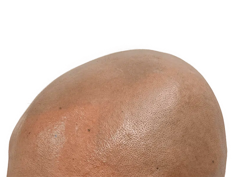 Hair transplant result: Fuller hair on dark skin. Before/after hair restoration showcasing density and even distribution.