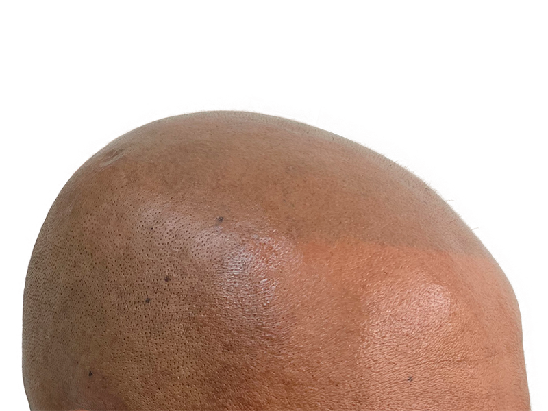 Hair transplant result: Bald scalp with visible follicles. Hair restoration before & after. African American/Hispanic.