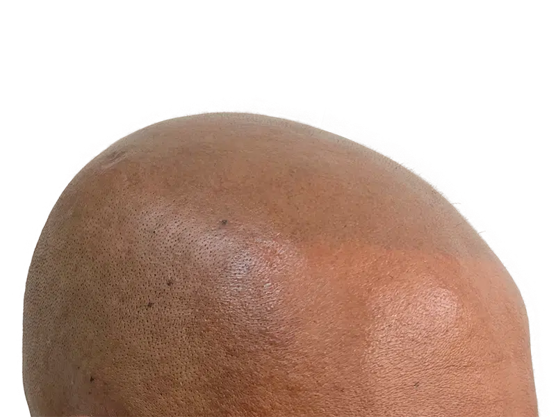 Hair transplant result: Bald scalp with visible follicles. Hair restoration before & after. African American/Hispanic.