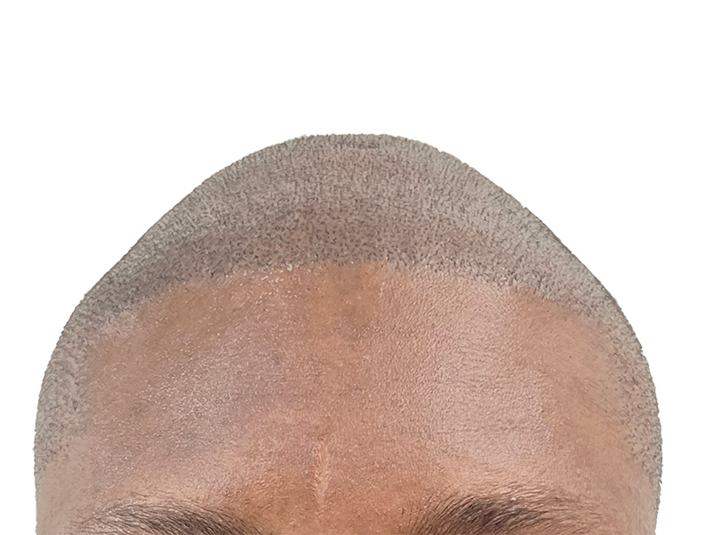 Hair transplant result: Close-up of restored hairline. Even, dense hair growth after hair restoration procedure.
